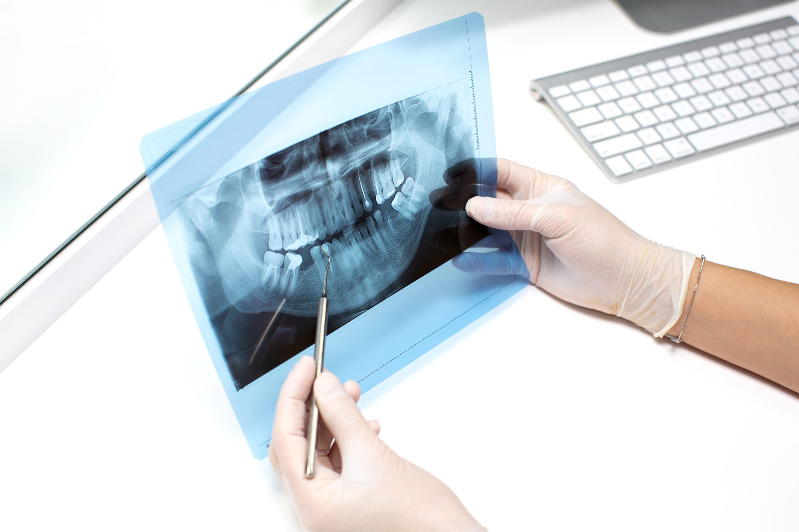 Почему стоматологи настаивают на удалении зуба мудрости?